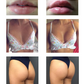 asting penis enlargement cross linked hyaluronic acid dermal filler penis filler injection for sale  