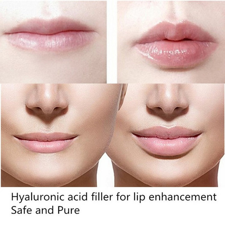 Injection  Cross Linked Hyaluronic Acid Filler